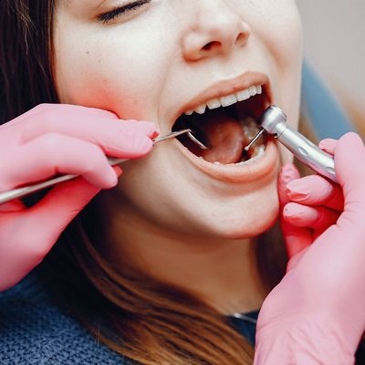 Dental Scaling & Polishing in Dubai - Teeth Cleaning Dental Clinic