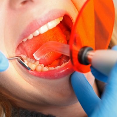 Dental Tooth Filling in Dubai & Abu Dhabi Teeth Filling