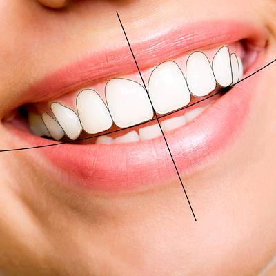 Digital Smile Design in Dubai - New Digital Smile Dental Clinic
