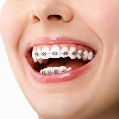 Metal Braces in Dubai - Braces Orthodontic Dental Clinic