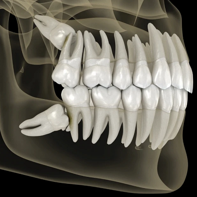 Wisdom Tooth Extraction in Dubai Dental Clinic Dubai