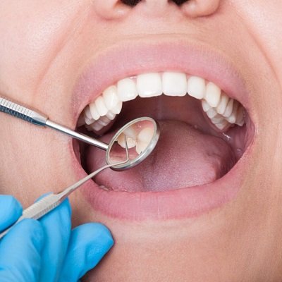 Composite Filling In Dubai & Abu Dhabi Dental Clinic Dubai