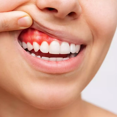 Dental Implant Infection in Dubai & Abu Dhabi Price & Cost