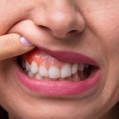 Gum Depigmentation In Dubai Gum Bleaching Price & Cost