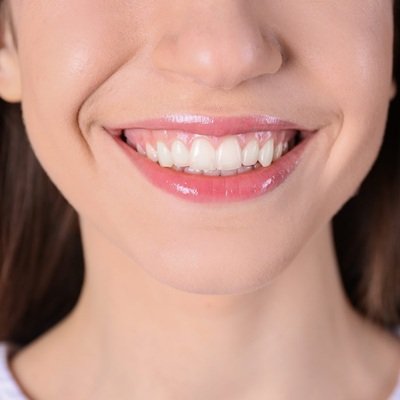 Best E-Max Veneers in Dubai - Emax Veneers