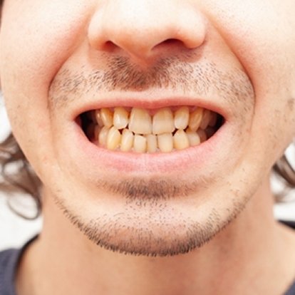 Best Teeth Whitening