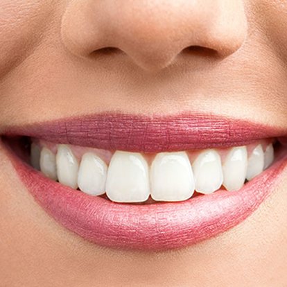 Teeth whitening Dubai