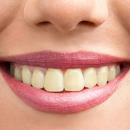 Teeth whitening Dubai