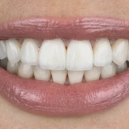 Best Teeth polishing & scaling dubai