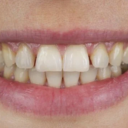 Best Teeth polishing & scaling dubai