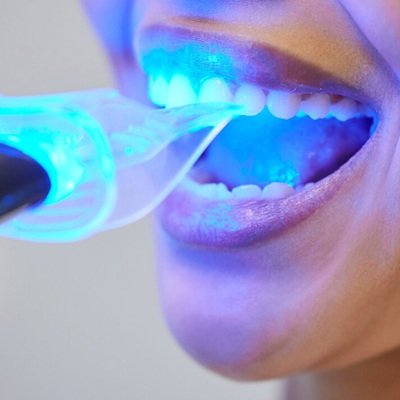 Best Zoom Teeth Whitening In Dubai -Enfield Dental Clinic