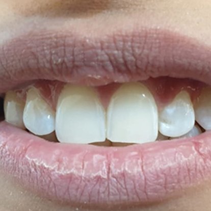Best Zoom teeth Whitening