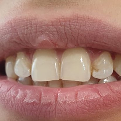 Best Zoom teeth Whitening