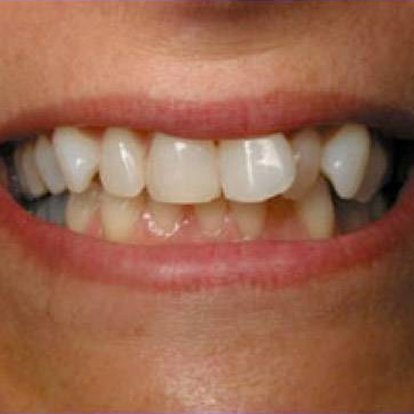 Dental Braces Dubai B