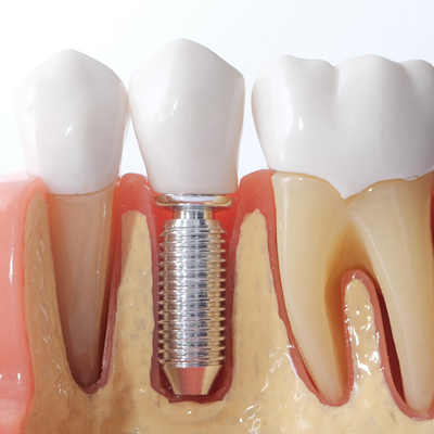 [⚠️ Suspicious Content] Best Dental Implants in Dubai | Dental Implant Surgery