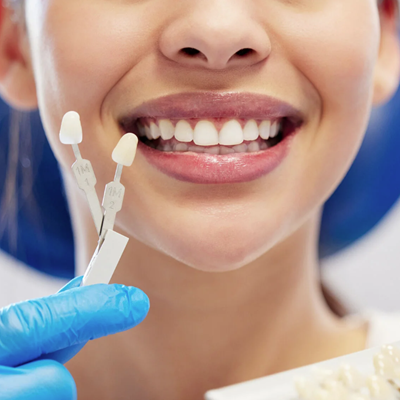 Dental Veneers in Dubai - Best Veneers Clinic