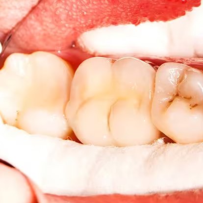 Root canal Treatment A