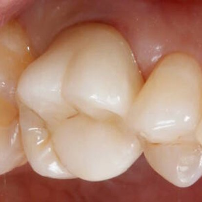 Root canal Treatment After