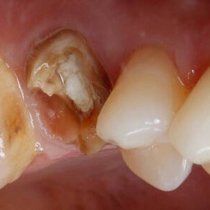 Root canal Treatment Before