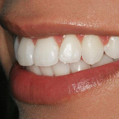 Teeth Braces Dubai A