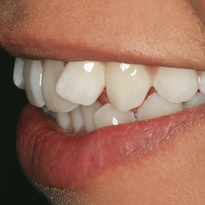 Teeth Braces Dubai B