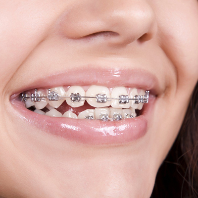 Teeth Braces in Dubai - Dental Braces Treatment