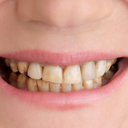 Teeth polishing & scaling