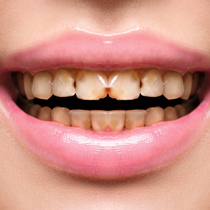 Teeth polishing & scaling dubai
