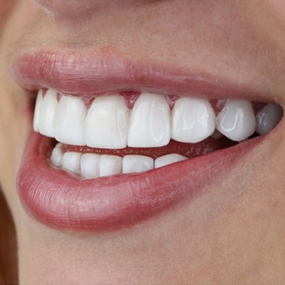 Zoom teeth Whitening