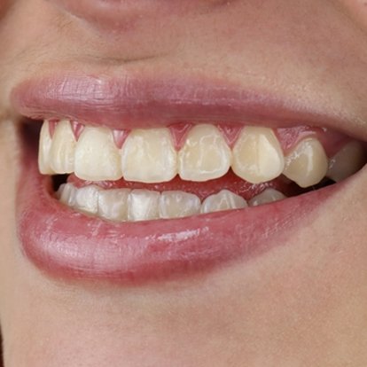 Zoom teeth Whitening