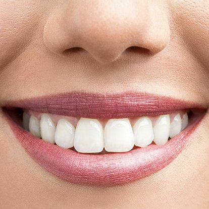 Zoom teeth Whitening Dubai