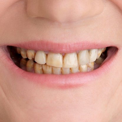 Cosmetic Dentistry in Dubai B