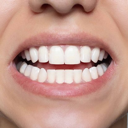 Digital Smile Design A