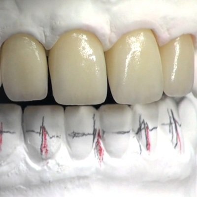 Lithium Disilicate Veneers in Dubai - Dental Veneers