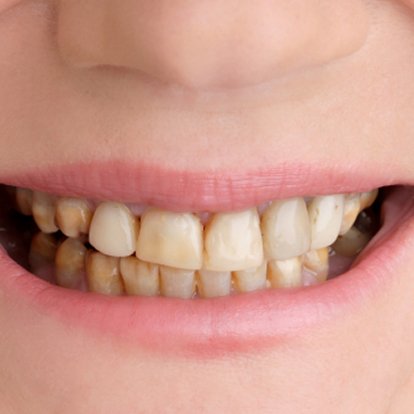 dental stain Removal