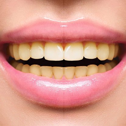 dental stain Removal Dubai