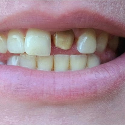 Best Ceramic Crown Dubai