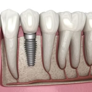 Dental Implant Cost in Dubai