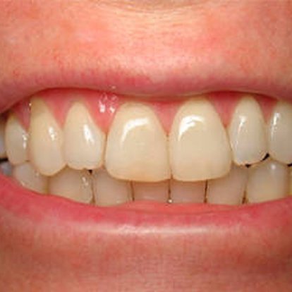 Ceramic Crown in Dubai