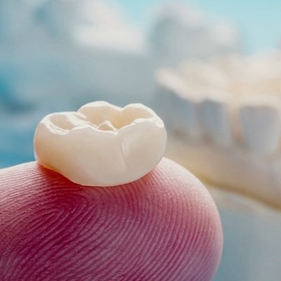 Best Ceramic Crown Dubai | Enfield Dental Clinic Dubai