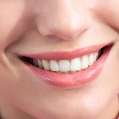 Crowded Teeth Treatment in Dubai - Best Dental Crowding