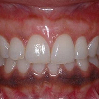 Best Gum Depigmentaion in Dubai