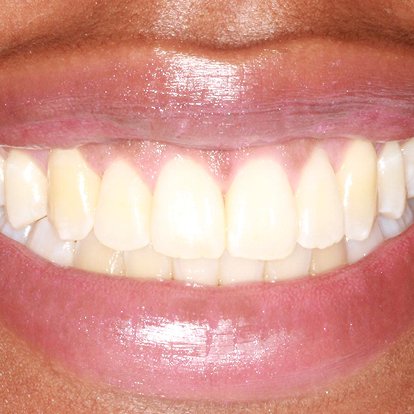 Gum Depigmentaion Dubai