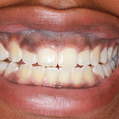 Gum Depigmentaion Dubai