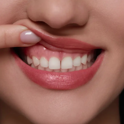 Gummy Smile Treatment In Dubai - Best Gummy Smile in Dubai