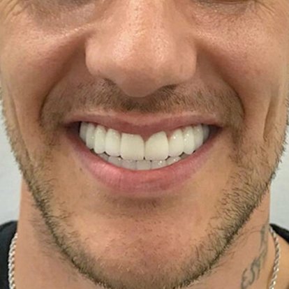 Zirconia Crown in Dubai