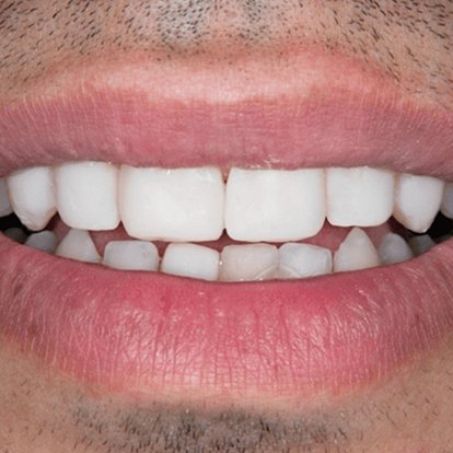 Zirconia Crown in Dubai