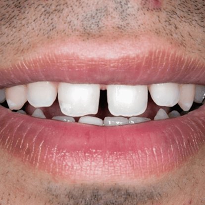 Zirconia Crown in Dubai