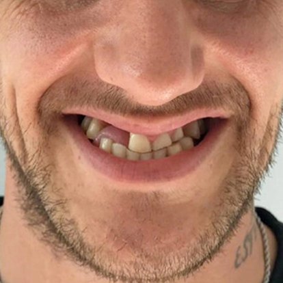 Zirconia Crown in Dubai