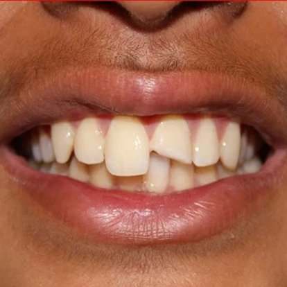 Zirconia Crown in Dubai